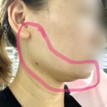 ハイフやってみた湘南美容体験談で効果は?【画像あり】HIFUは切らないフェイスリフト!